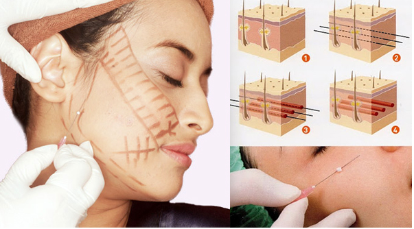 Trong các phương pháp căng da mặt, căng da mặt bằng chỉ dù nhẹ nhàng hơn cả cũng có rủi ro biến chứng đi kèm! - Ảnh 5.