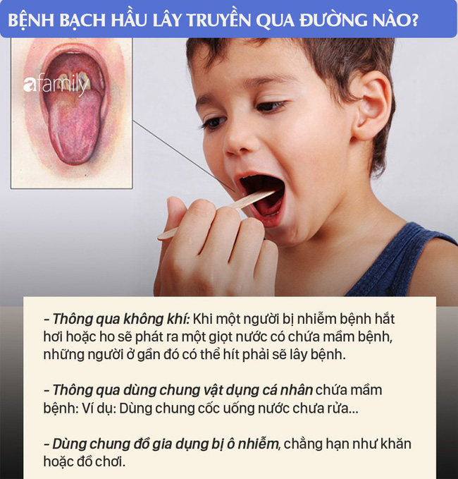 Phát hiện 1 ca dương tính, 2 ca nghi mắc bệnh bạch hầu ở Quảng Nam: Biến chứng của bệnh bạch hầu nguy hiểm thế nào? - Ảnh 2.