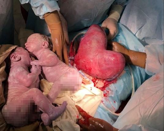 Mổ bắt thai cho mẹ bầu, bác sĩ sững sờ khi phát hiện tử cung của sản phụ có hình... trái tim - Ảnh 1.