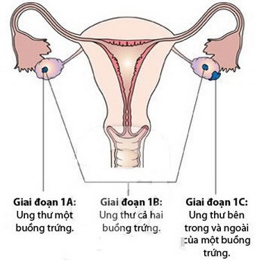 Cảnh báo sớm về ung thư buồng trứng - Ảnh 1.