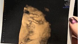 Đi siêu âm thai ở tuần 31, mẹ hết hồn khi thấy con gái đang giơ tay chào mình