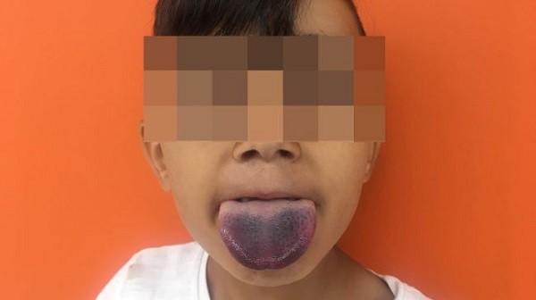 Cố gắng uống những giọt nước trái cây cuối cùng, lưỡi cậu bé 7 tuổi mắc kẹt trong cổ chai - Ảnh 2.