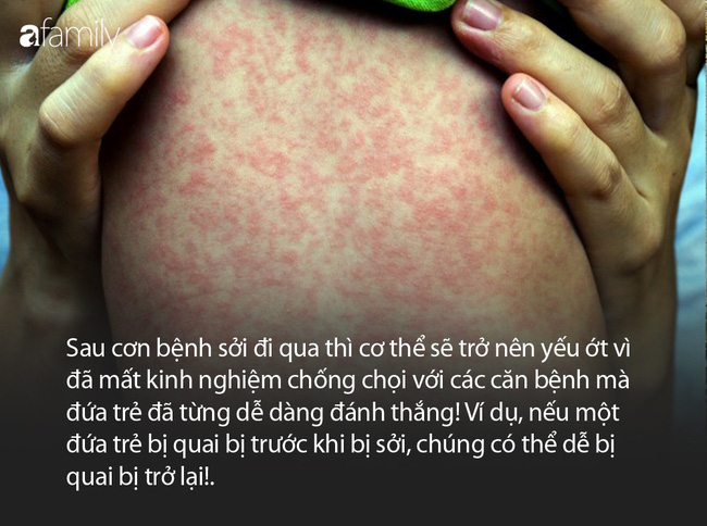 Virus sởi có thể xóa sạch bộ nhớ hệ miễn dịch của trẻ, dù bận đến mấy cha mẹ cũng phải đưa trẻ đi tiêm chủng khi được 9 tháng tuổi - Ảnh 2.