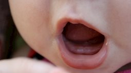 Chẩn đoán nhầm chuyện mọc răng, bé 7 tháng tuổi tử vong 3 ngày sau vì viêm màng não