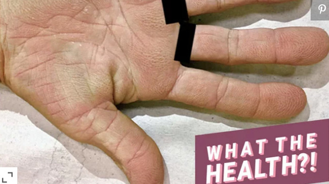 Cảnh báo: Nếu bạn xuất hiện dấu hiệu này ở lòng bàn tay, rất có thể đã bị ung thư phổi! - Ảnh 1.