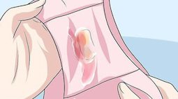 3 dấu hiệu tiết dịch âm đạo ngầm cảnh báo bệnh ung thư cổ tử cung mà nữ giới thường chủ quan bỏ qua