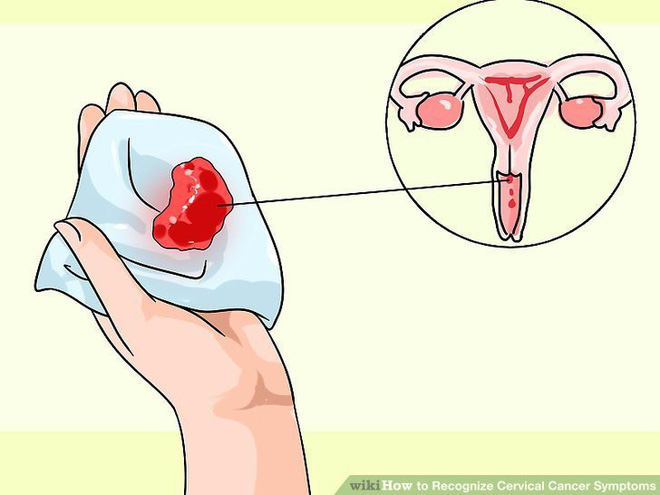 3 dấu hiệu tiết dịch âm đạo ngầm cảnh báo bệnh ung thư cổ tử cung mà nữ giới thường chủ quan bỏ qua - Ảnh 3.