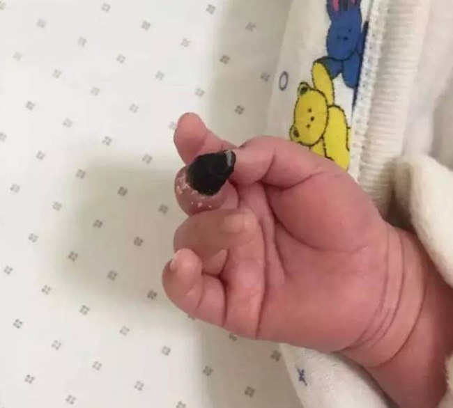 Bé 6 tháng tuổi phải cắt bỏ ngón tay giữa, người mẹ sốc khi biết nguyên nhân - Ảnh 1.