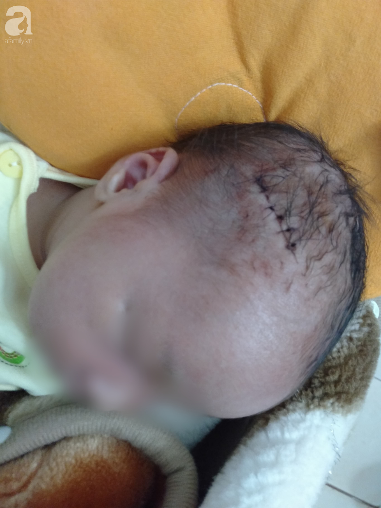 Nóng: Bệnh viện mổ bắt con khiến bé trai sơ sinh bị rách đầu, khâu 6 mũi, có biểu hiện sốt, co giật - Ảnh 2.
