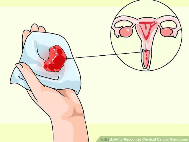 3 dấu hiệu tiết dịch âm đạo ngầm cảnh báo bệnh ung thư cổ tử cung mà nữ giới thường chủ quan bỏ qua - Ảnh 2.