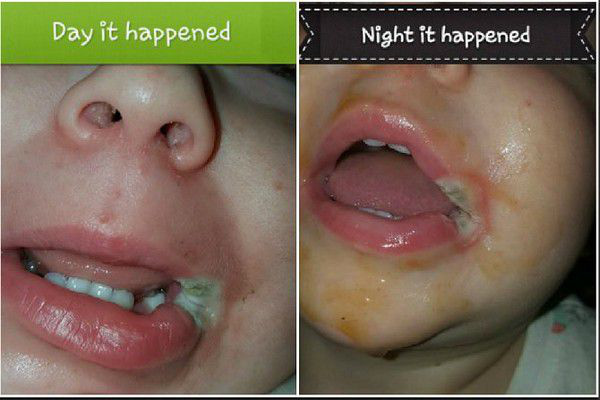 Dùng sạc điện thoại xong không rút điện, bé 2 tuổi ngậm đầu sạc bị giật rách khoang miệng, tổn thương amidan - Ảnh 5.
