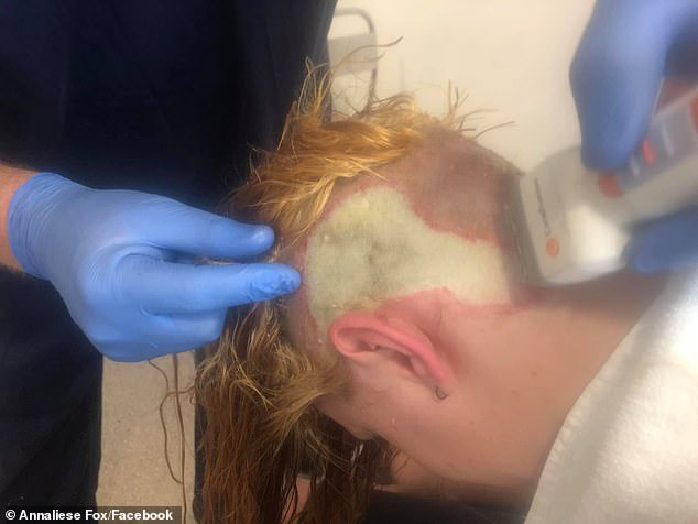 Cô gái người Úc mất luôn một mảng tóc trên da đầu, thậm chí còn có nguy cơ phải ghép da vì hành động tự tẩy tóc tại nhà - Ảnh 3.