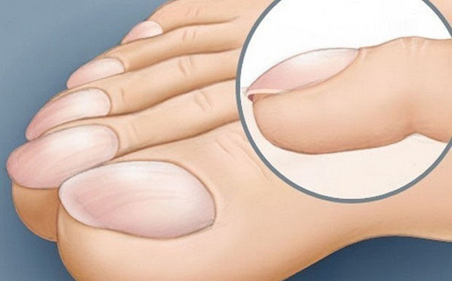 4 dấu hiệu dễ thấy trên bàn tay và bàn chân lại ngầm cảnh báo bệnh ung thư ác tính mà nhiều người không biết - Ảnh 3.