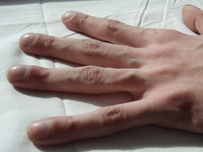 4 dấu hiệu dễ thấy trên bàn tay và bàn chân lại ngầm cảnh báo bệnh ung thư ác tính mà nhiều người không biết - Ảnh 4.