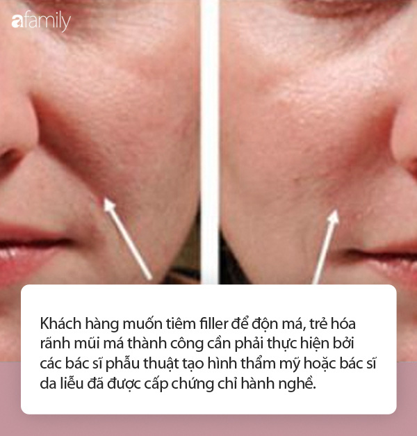 Nhiều người gặp biến chứng do tiêm filler trẻ hóa khuôn mặt, chuyên gia cảnh báo cần hết sức cẩn trọng - Ảnh 2.