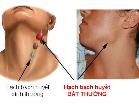 Ðau một bên họng - Vì sao? - Ảnh 1.