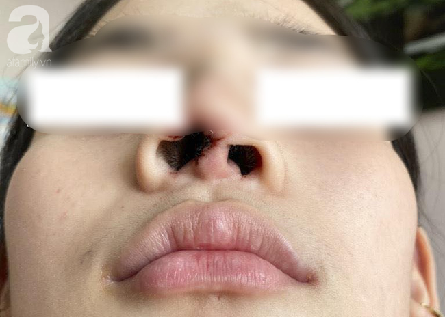 Đi nâng mũi tại spa, thiếu nữ 16 tuổi ở TP.HCM bị nhiễm trùng, biến dạng nặng nề đầu mũi - Ảnh 1.