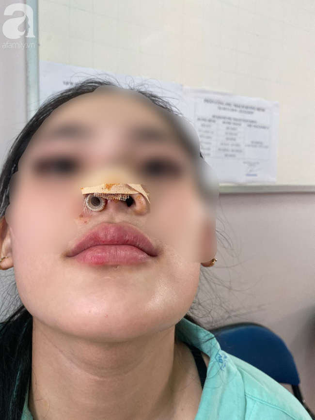 Đi nâng mũi tại spa, thiếu nữ 16 tuổi ở TP.HCM bị nhiễm trùng, biến dạng nặng nề đầu mũi - Ảnh 3.