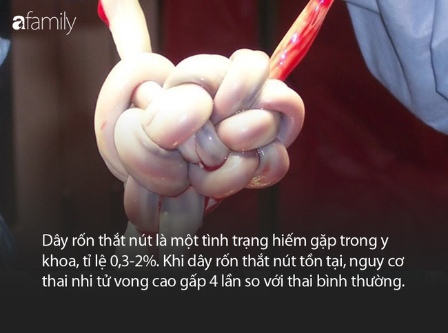 Dây rốn thắt nút nguy hiểm thế nào mà khiến thai nhi 40 tuần tuổi tử vong trong bụng mẹ tại Bệnh viện Từ Dũ - Ảnh 3.