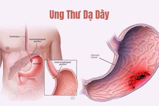 Sự khác biệt giữa ung thư dạ dày và đau dạ dày: Phân biệt để không bỏ lỡ cơ hội điều trị - Ảnh 1.