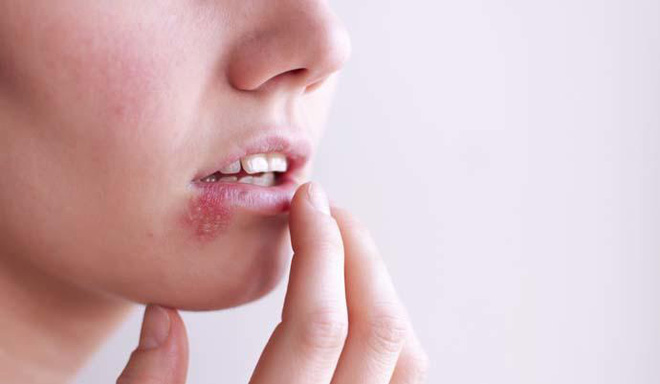 Đôi môi của cô gái 16 tuổi bị loét nghiêm trọng, đi khám mới phát hiện mình nhiễm HPV do thói quen xấu từ người mẹ - Ảnh 1.