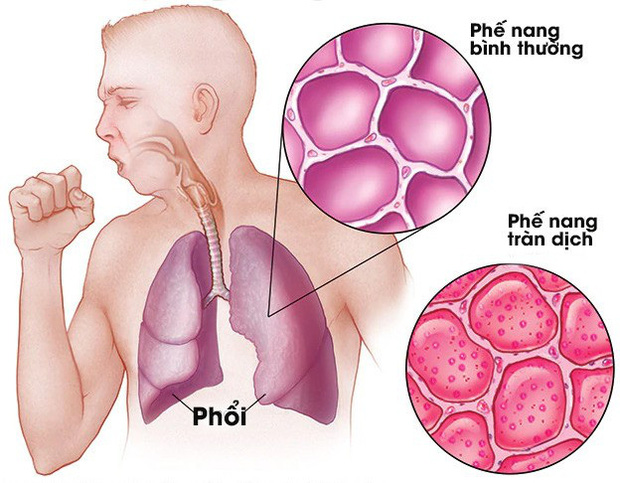 [Infographic] Đây là cách virus Covid-19 tàn phá cơ thể người - Ảnh 5.