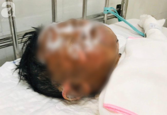 Bé trai 6 tuổi bị dì ruột tẩm xăng đốt ở Vũng Tàu phải điều trị lâu dài cả về thể xác lẫn tâm lý - Ảnh 2.