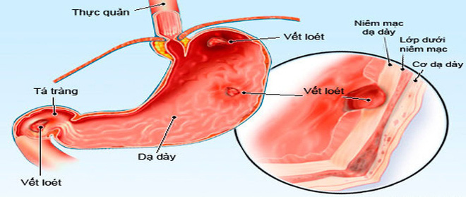 Chuyên gia chỉ ra thủ phạm  đang bức tử dạ dày của nhiều người  - Ảnh 1.