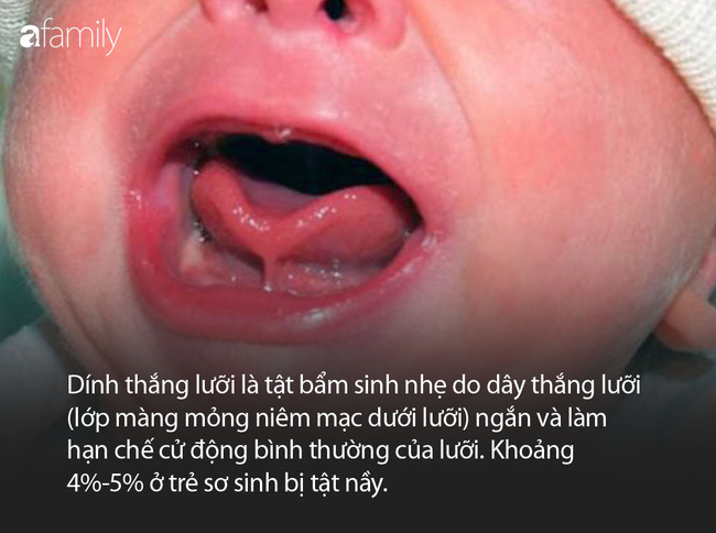 Vừa mới sinh được 2 ngày, con gái diễn viên xiếc Quốc Cơ đã phải vào phòng phẫu thuật vì dị tật 5% trẻ sơ sinh mắc phải - Ảnh 3.