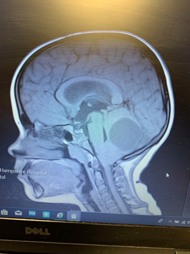 2 năm không đi kiểm tra mắt, bé gái 8 tuổi bất ngờ bị phát hiện có khối u trong não - Ảnh 2.