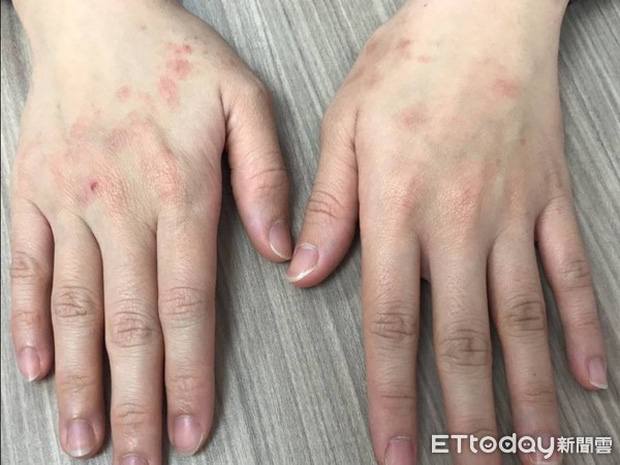 Lạm dụng nước rửa tay khô trong mùa dịch COVID-19: chuyên gia cảnh báo có thể gây tổn thương đến đôi tay - Ảnh 2.