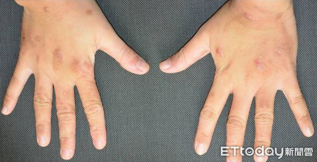 Lạm dụng nước rửa tay khô trong mùa dịch COVID-19: chuyên gia cảnh báo có thể gây tổn thương đến đôi tay - Ảnh 7.