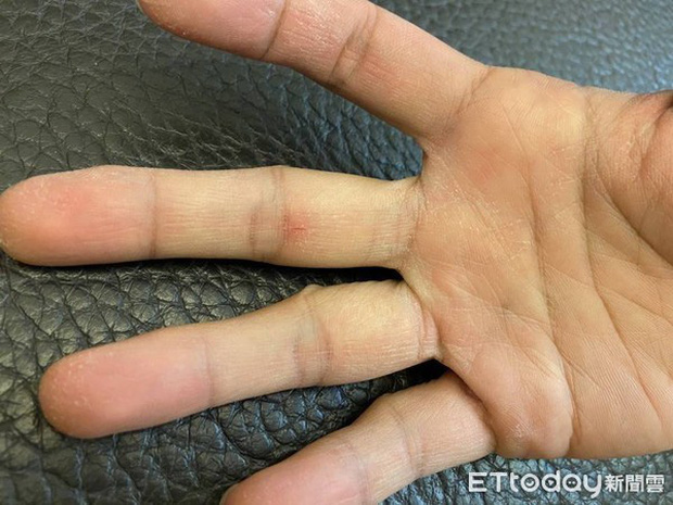 Lạm dụng nước rửa tay khô trong mùa dịch COVID-19: chuyên gia cảnh báo có thể gây tổn thương đến đôi tay - Ảnh 4.