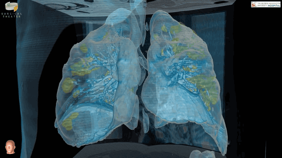 Ám ảnh với video thực tế ảo mô phỏng bên trong phổi của bệnh nhân nhiễm COVID-19 - Ảnh 2.