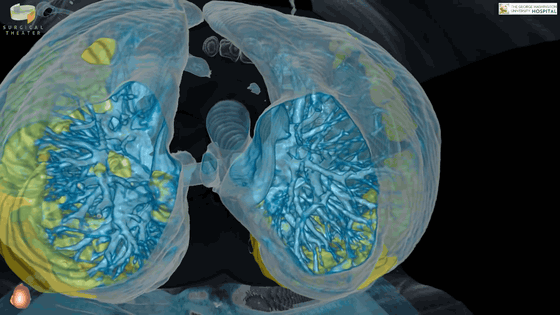 Ám ảnh với video thực tế ảo mô phỏng bên trong phổi của bệnh nhân nhiễm COVID-19 - Ảnh 3.