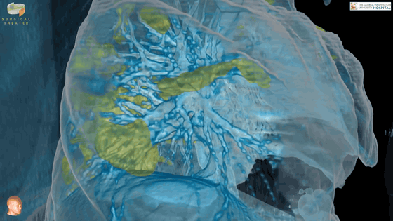 Ám ảnh với video thực tế ảo mô phỏng bên trong phổi của bệnh nhân nhiễm COVID-19 - Ảnh 4.