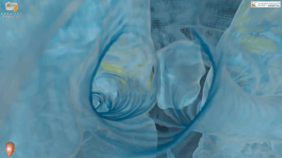 Ám ảnh với video thực tế ảo mô phỏng bên trong phổi của bệnh nhân nhiễm COVID-19 - Ảnh 5.
