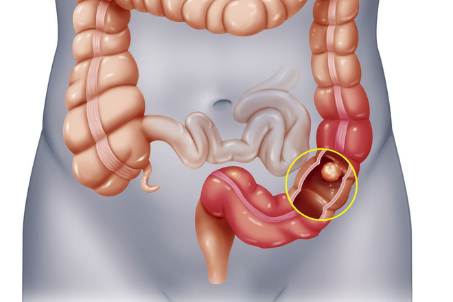 Cùng mắc ung thư, có người chữa khỏi nhưng có người tử vong: Do 3 điểm khác biệt cần biết - Ảnh 5.