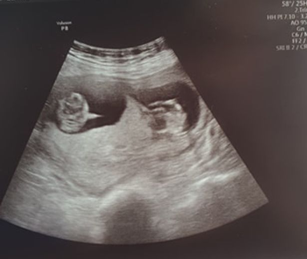 Sau 10 ngày rơi vào hôn mê do bị nhiễm virus corona, bà mẹ tỉnh dậy vui mừng khi biết tin mình mang thai một cặp song sinh - Ảnh 2.