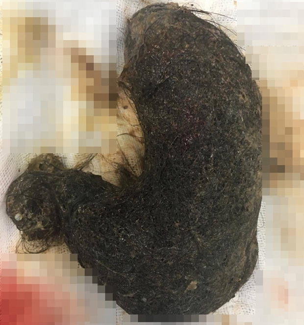 Bé gái 11 tuổi ở Hà Nội có khối u khổng lồ trong cơ thể chứa toàn tóc, nguyên nhân do 1 thói quen từ năm 2 tuổi của bé  - Ảnh 1.