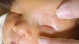 Siêu âm cả thai kỳ đều bình thường, mẹ sốc khi con chào đời không có mắt