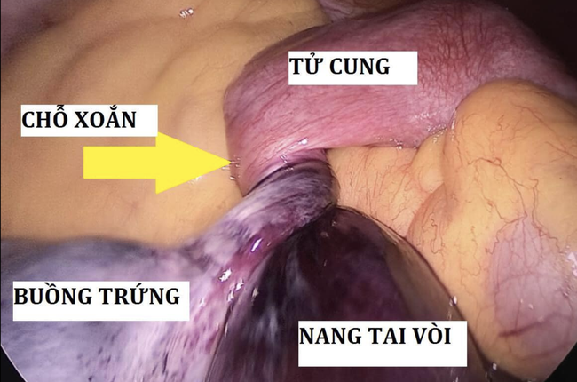 TP.HCM: Đau bụng dữ dội, bé gái 11 tuổi phải mổ khẩn cấp vì căn bệnh nguy hiểm có thể gây vô sinh - Ảnh 1.