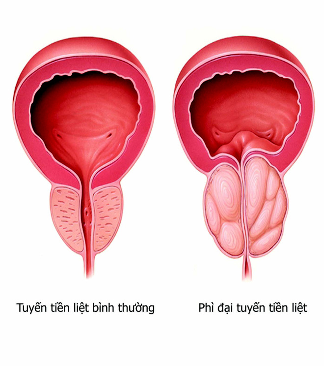 Căn bệnh khó nói khiến nam giới tiểu nhiều, tiểu gấp: 3 bước để phát hiện và điều trị - Ảnh 2.