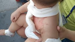 Tai nạn đau lòng: Đùa giỡn với anh trai, bé 2 tuổi bị tô mì tôm úp vào người gây bỏng nặng