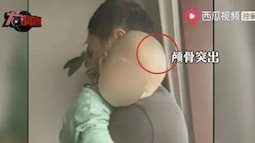 Trung Quốc: Một số trẻ em mắc bệnh "đầu to" sau khi uống 1 loại sữa công thức trong thời gian dài