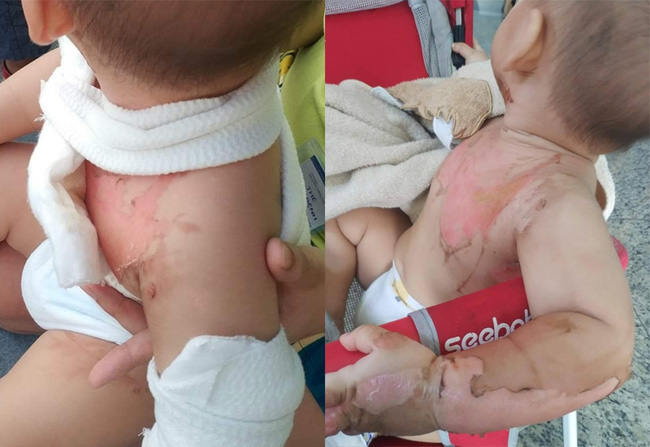 Tai nạn đau lòng: Đùa giỡn với anh trai, bé 2 tuổi bị tô mì tôm úp vào người gây bỏng nặng - Ảnh 1.
