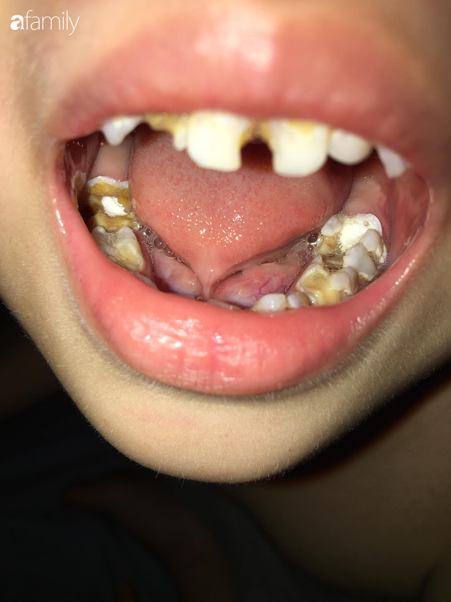 Từng nghĩ răng sữa sâu không sao, rồi sẽ thay, mẹ Hà Nội đã hối hận khi con trai phải gây mê để điều trị răng sâu - Ảnh 1.