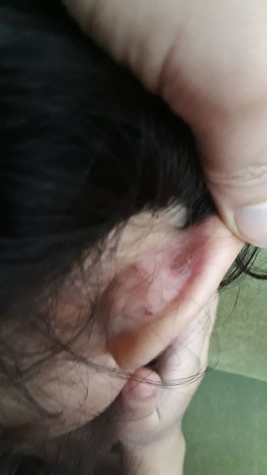 Phụ huynh ở Hà Nội tố con gái bị đánh véo đến dập môi tụ máu, nhưng cô giáo trả lời 