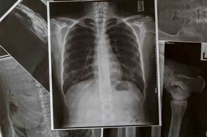 12 dấu hiệu cảnh báo phổi của bạn đang gặp vấn đề - Ảnh 2.