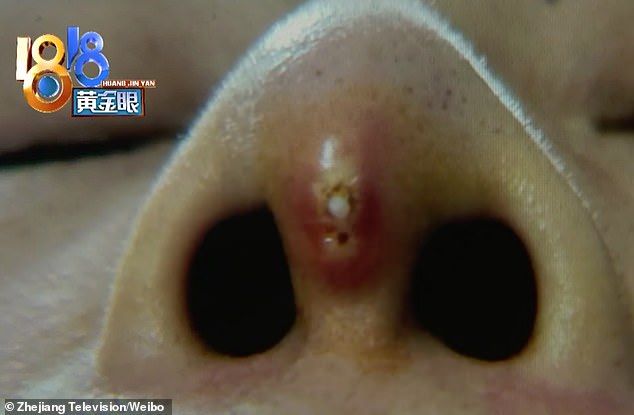 Một người phụ nữ phát hoảng khi thấy thanh silicone được cấy ghép trong mũi bỗng 
